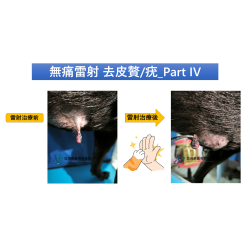 5/15 病歷分享－無痛雷射 去皮贅/疣_Part IV