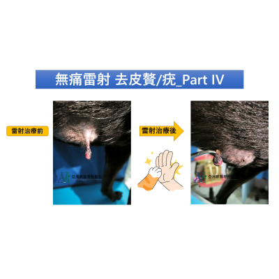5/15 病歷分享－無痛雷射 去皮贅/疣_Part IV