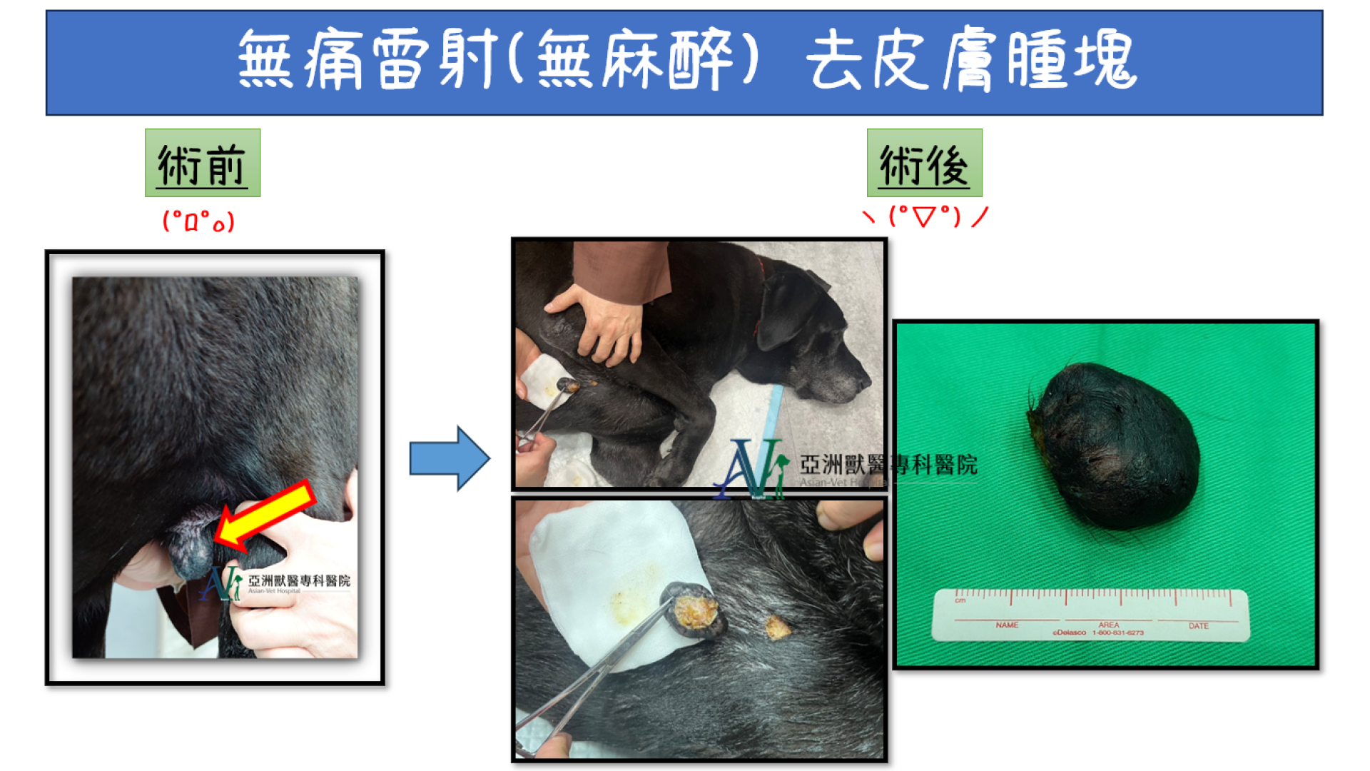 無痛雷射-去疣(皮贅)